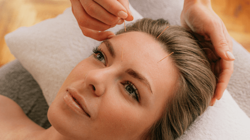 Facial acupuncture | Treatwell