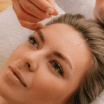 Facial acupuncture | Treatwell