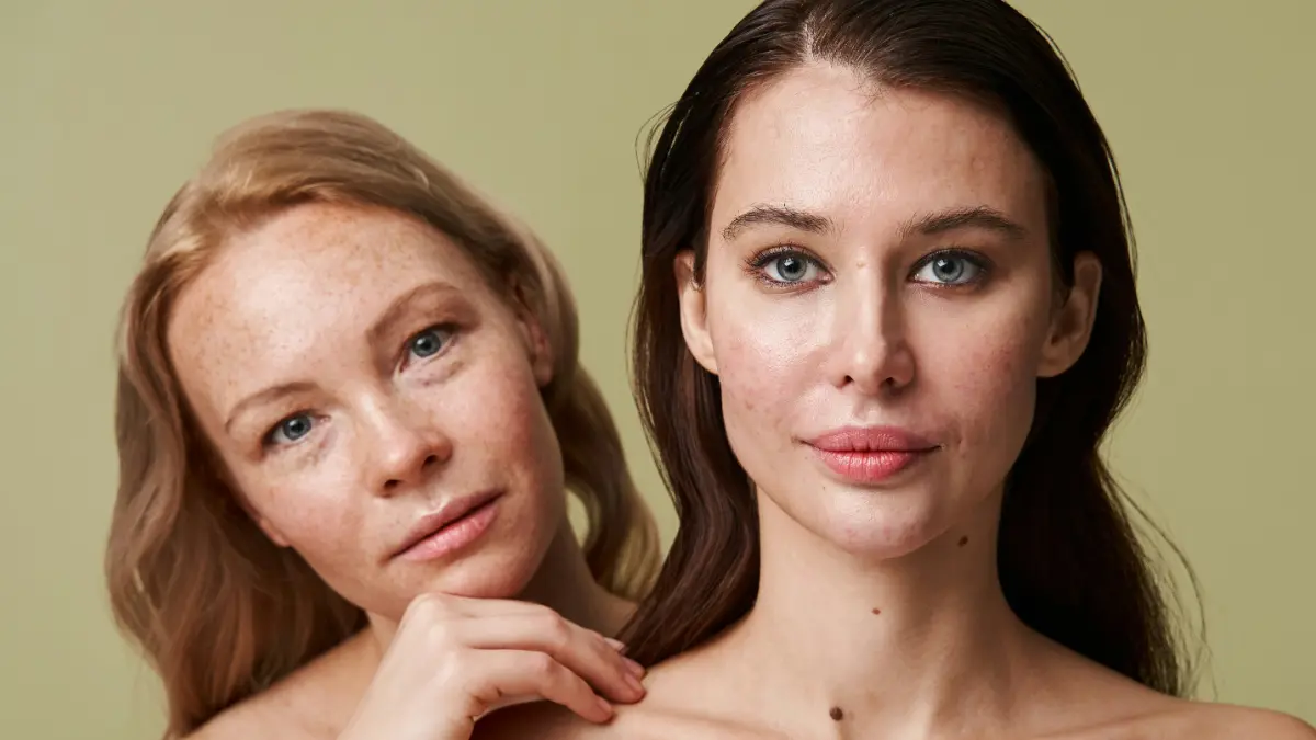 A blonde woman with freckles looks out from behind a brunette woman with acne skin